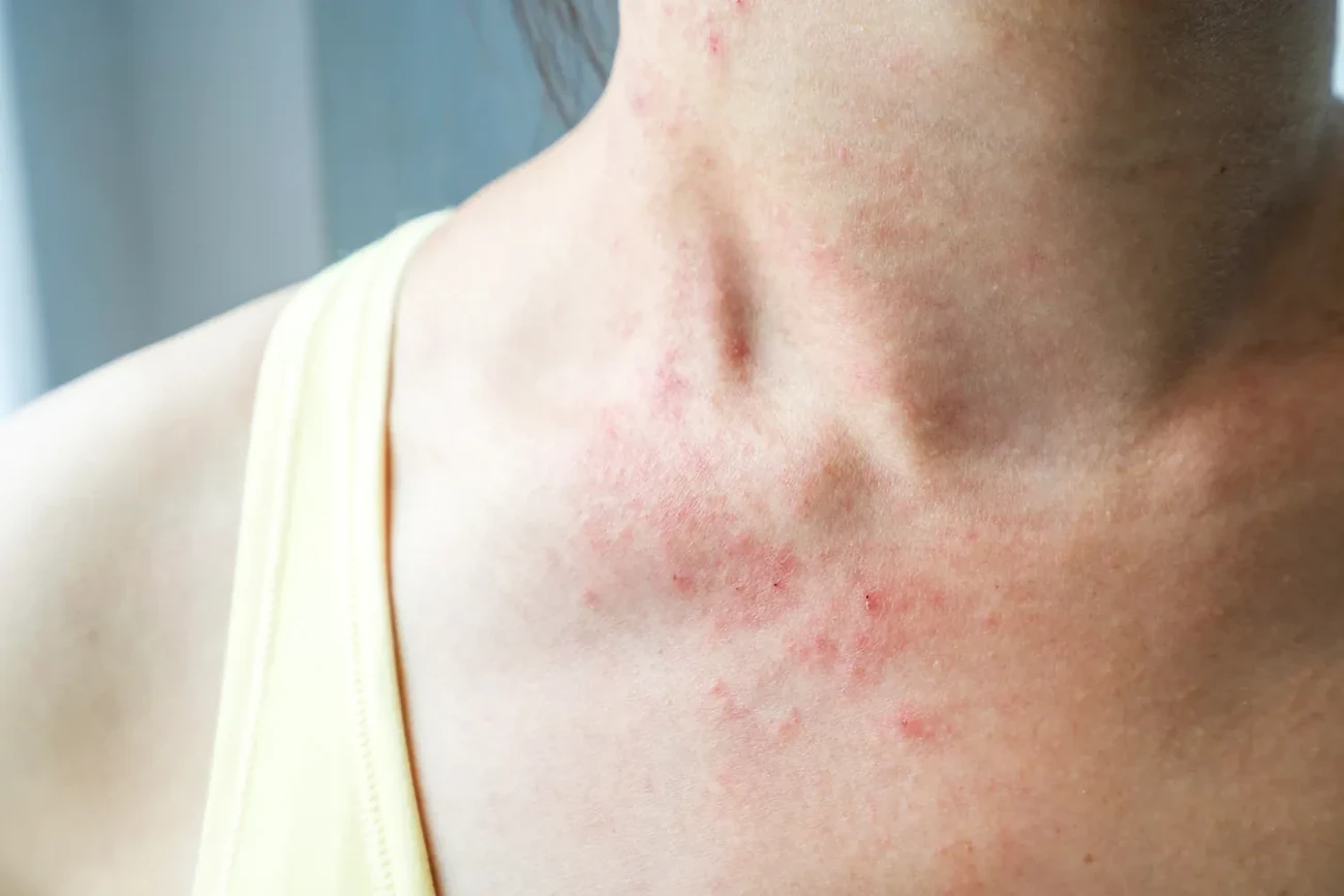 Article Problèmes de peau et hypnose : comment ça marche ?